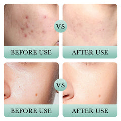 Bioaqua Salicylic Acid Acne Removal Cream Pores Oil Control Treatment